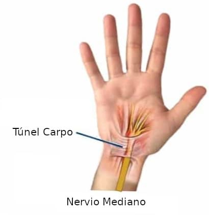 Secuelas después de la operación del túnel carpiano en Costa Rica
